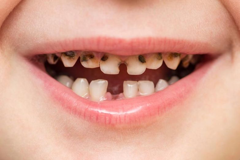 Почему у ребенка желтые зубы - «Стоматология на Марата 31»