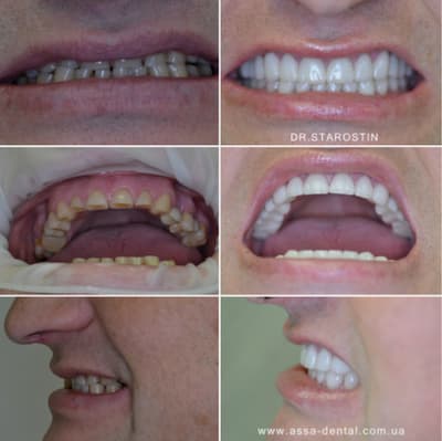 Патологическая стираемость всей группы зубов