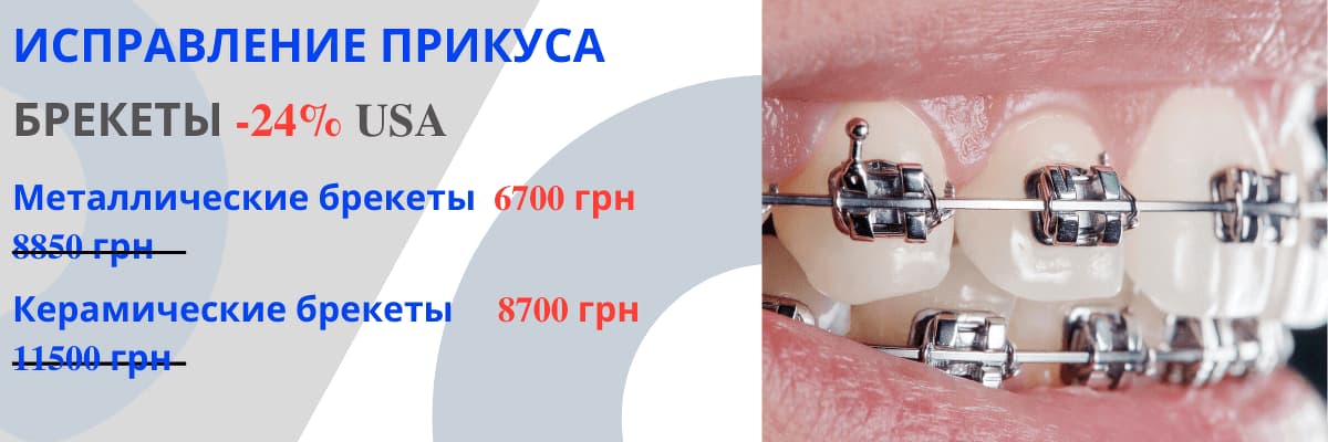 Брекет системы показания для установки виды и уход проект