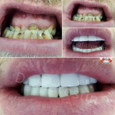Тотальная реконструкция зубного ряда