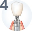 имплантация зубов под ключ цена