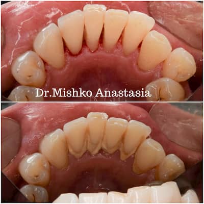 До и после чистки зубов центре асса