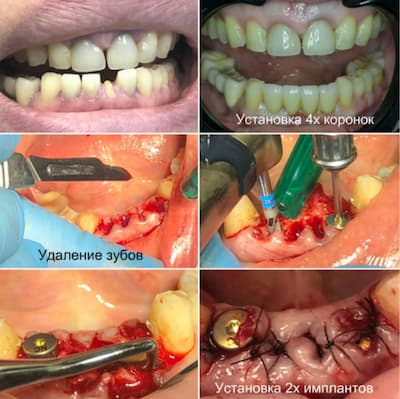 Наличие грануляций. Удаление зубов и одномоментная имплантация  