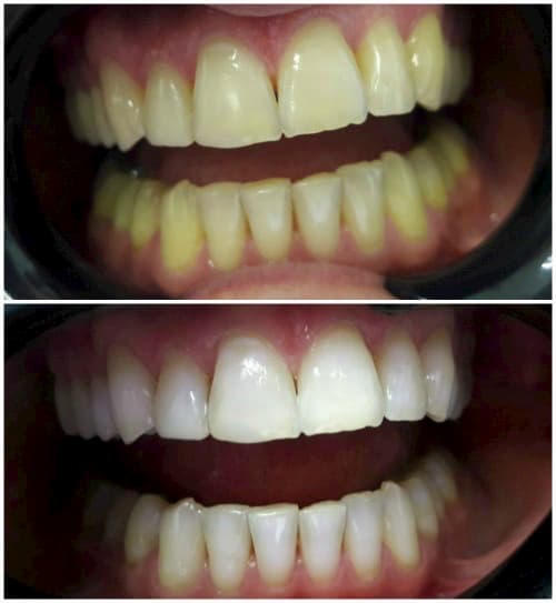 Result of teeth whitening