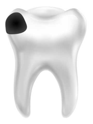 зуб с кариесом