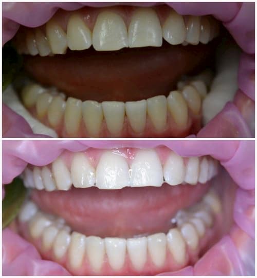Result of teeth whitening
