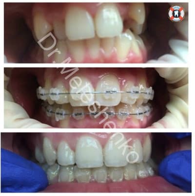 Orthodontic in assa dental clinic