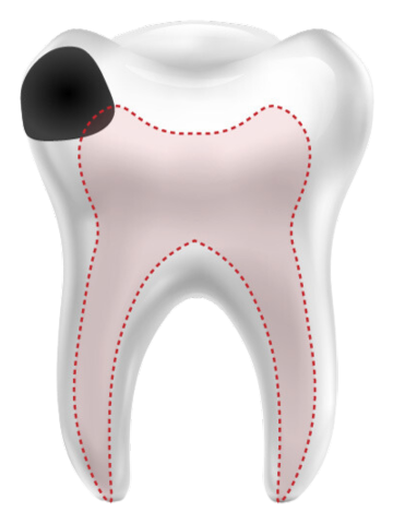 зуб с кариесом и каналами