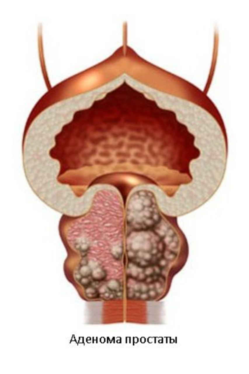 Лечение простатита и аденомы простаты в Тюмени