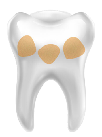 зуб с кариесом и каналами