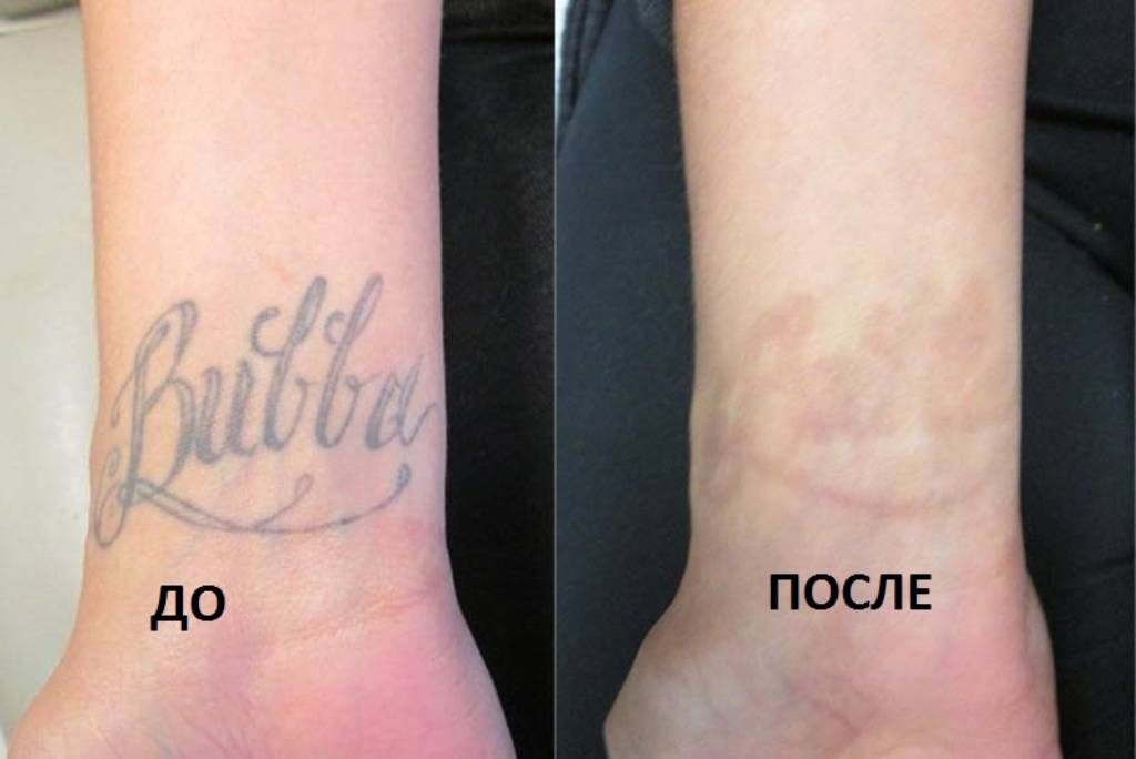 лазерное удаление татуировки в косметологии Дворик Красоты в городе Реутов