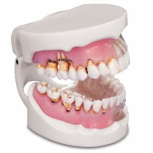 Лечение гингивита в стоматологии асса