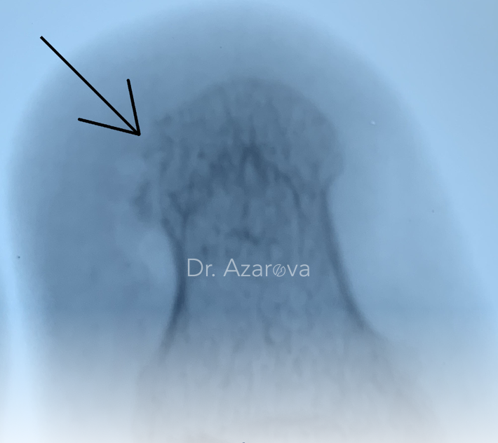 Рентген пальца при остеомиелите рентген пальца, остеомиелит фаланги пальца, вросший ноготь, онихокриптоз, лечение вросшего ногтя, удаление вросшего ногтя