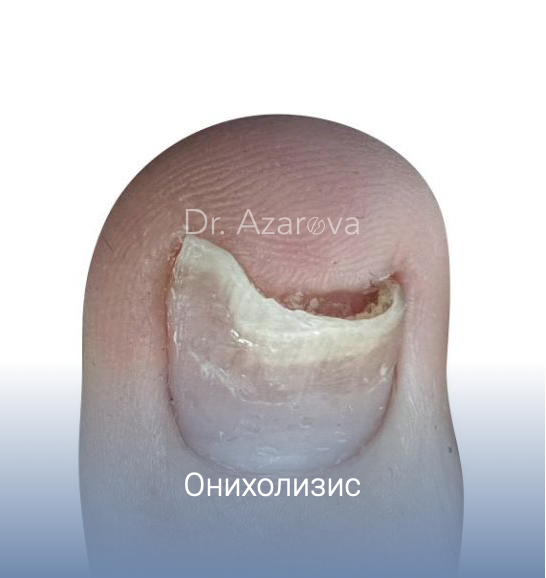 онихолизис, онихолизис ногтей что это, онихолизис лечение, онихолизис на ногах, онихолизис ногтей на ногах