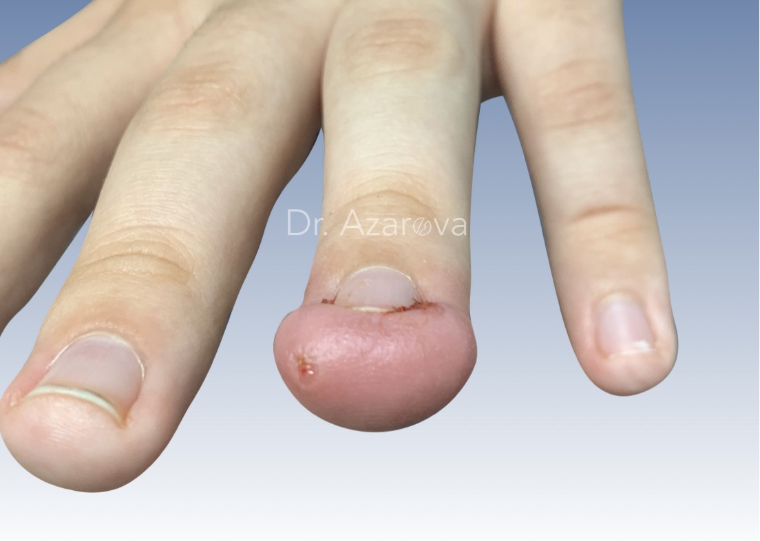 Вросший ноготь пальца кисти вросший ноготь, вросшие ногти, вросший ноготь на ноге, вросший ноготь на пальце стопы, вросший ноготь пальца стопы, лечение вросшего ногтя, удаление вросшего ногтя