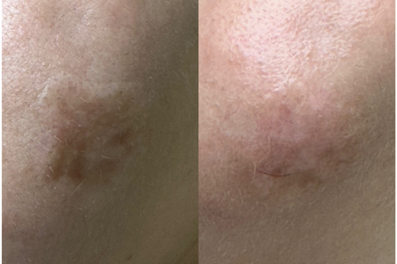 Камуфляж шрамов Москва Камуфляж шрамов Москва