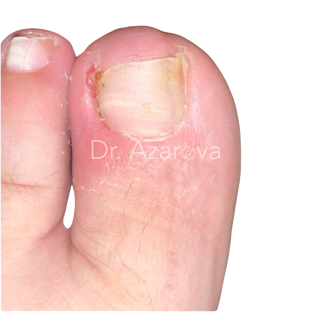 Вросший ноготь: причины, симптомы, диагностика, лечение, удаление, операция, фото, отзывы, лучшие врачи