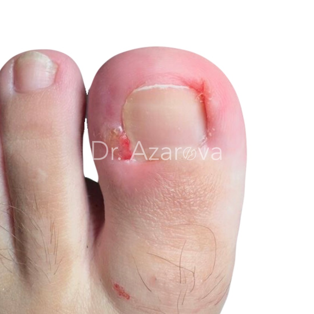 вросший ноготь результаты лечения, вросший ноготь на ноге, лечение вросшего ногтя, удаление вросшего ногтя, удаление ногтя, до и после, лечение до и после