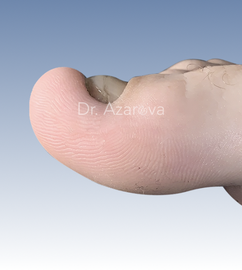 экзостоз, подногтевой экзостоз, удаление экзостоза, экзостоз пальца