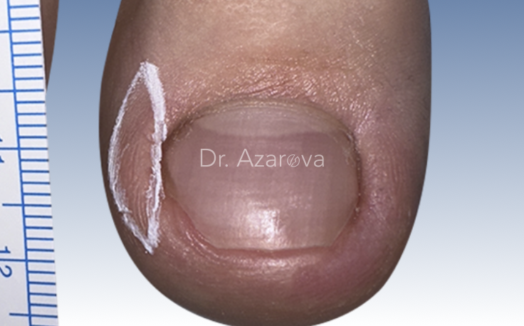 Пластика валика при вросшем ногте вросший ноготь, онихокриптоз, титановая нить, ортониксия, скоба Фрезера, лечение вросшего ногтя, ортониксия, титановая нить, удаление вросшего ногтя, пластика валика