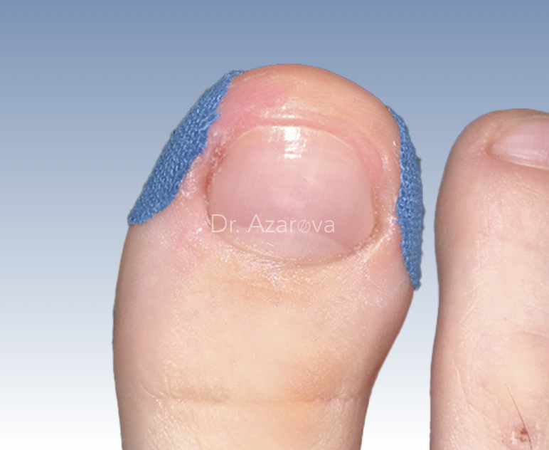 Вросший ноготь лечение вросший ноготь, онихокриптоз, лечение вросшего ногтя, тейпирование валика, тейпирование вросшего ногтя