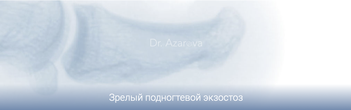 экзостоз ногтевой, подногтевой экзостоз  рентген пальца