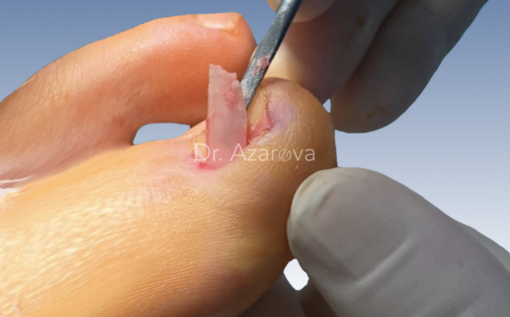 Удаление ногтя вросший ноготь, онихокриптоз, лечение вросшего ногтя, ортониксия, титановая нить, удаление вросшего ногтя, резекция вросшего ногтя, удаление ногтя