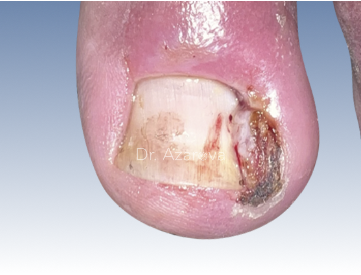 Вросший ноготь вросший ноготь, симптомы вросшего ногтя, вросший ноготь грануляция, дикое мясо, онихокриптоз, лечение вросшего ногтя, удаление вросшего ногтя