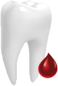 Кровоточивость дёсен Восстановление зуба