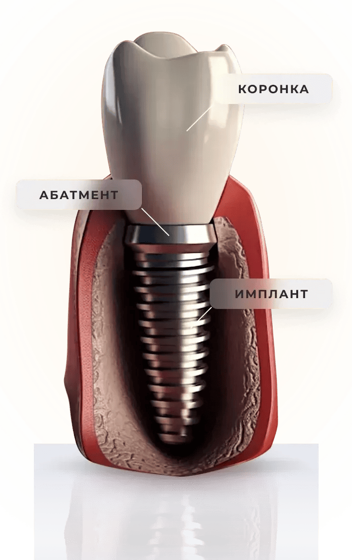 имплантация зубов севастополь