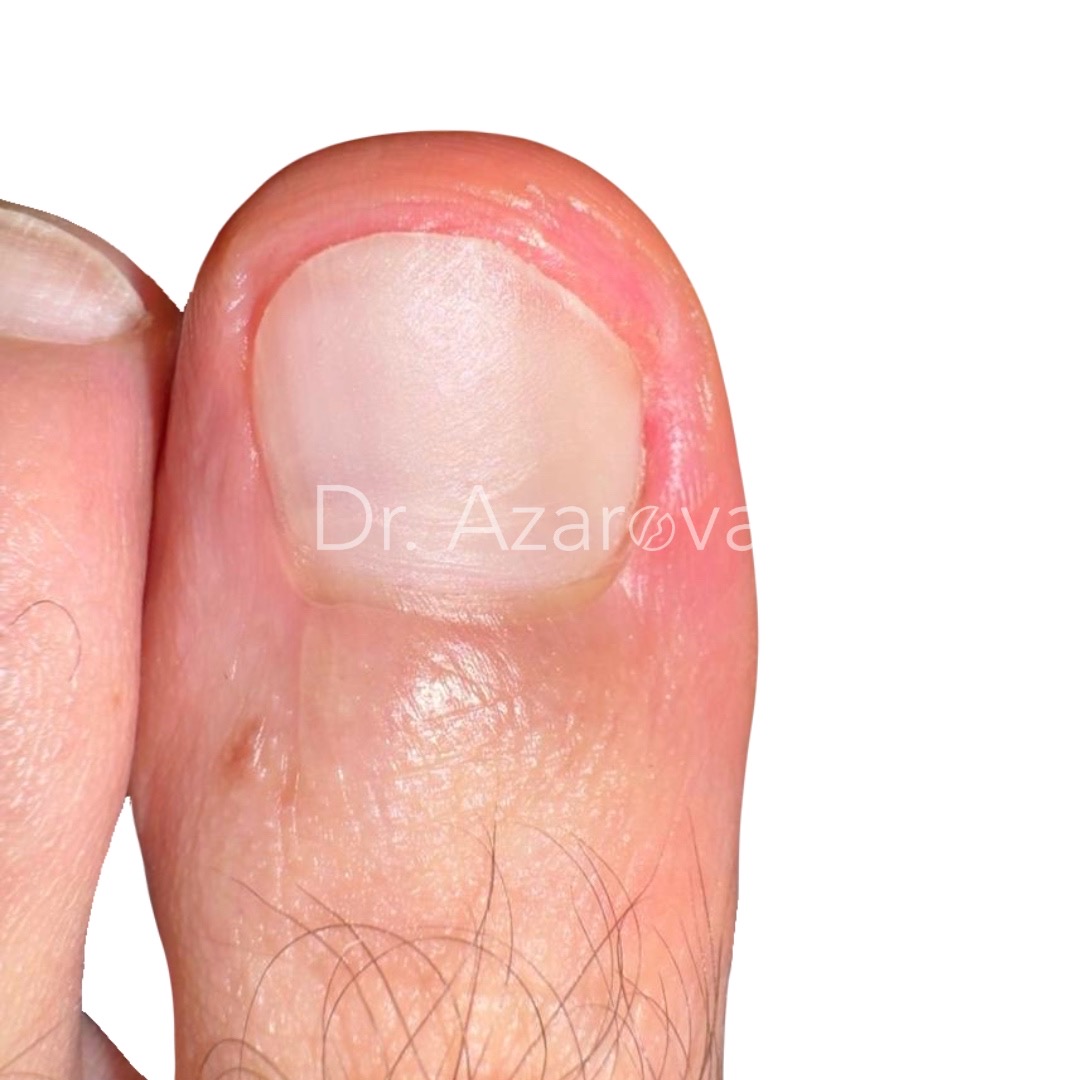 вросший ноготь результаты лечения, вросший ноготь на ноге, лечение вросшего ногтя, удаление вросшего ногтя, удаление ногтя, до и после, лечение до и после