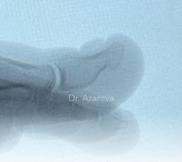 Рентген пальца при экзостозе подногтевой экзостоз, рентген пальца, вросший ноготь, вросший ноготь на ноге, онихокриптоз, лечение вросшего ногтя, удаление вросшего ногтя