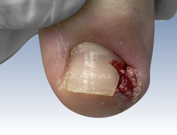 Симптомы вросшего ногтя вросший ноготь, онихокриптоз, лечение вросшего ногтя, удаление вросшего ногтя