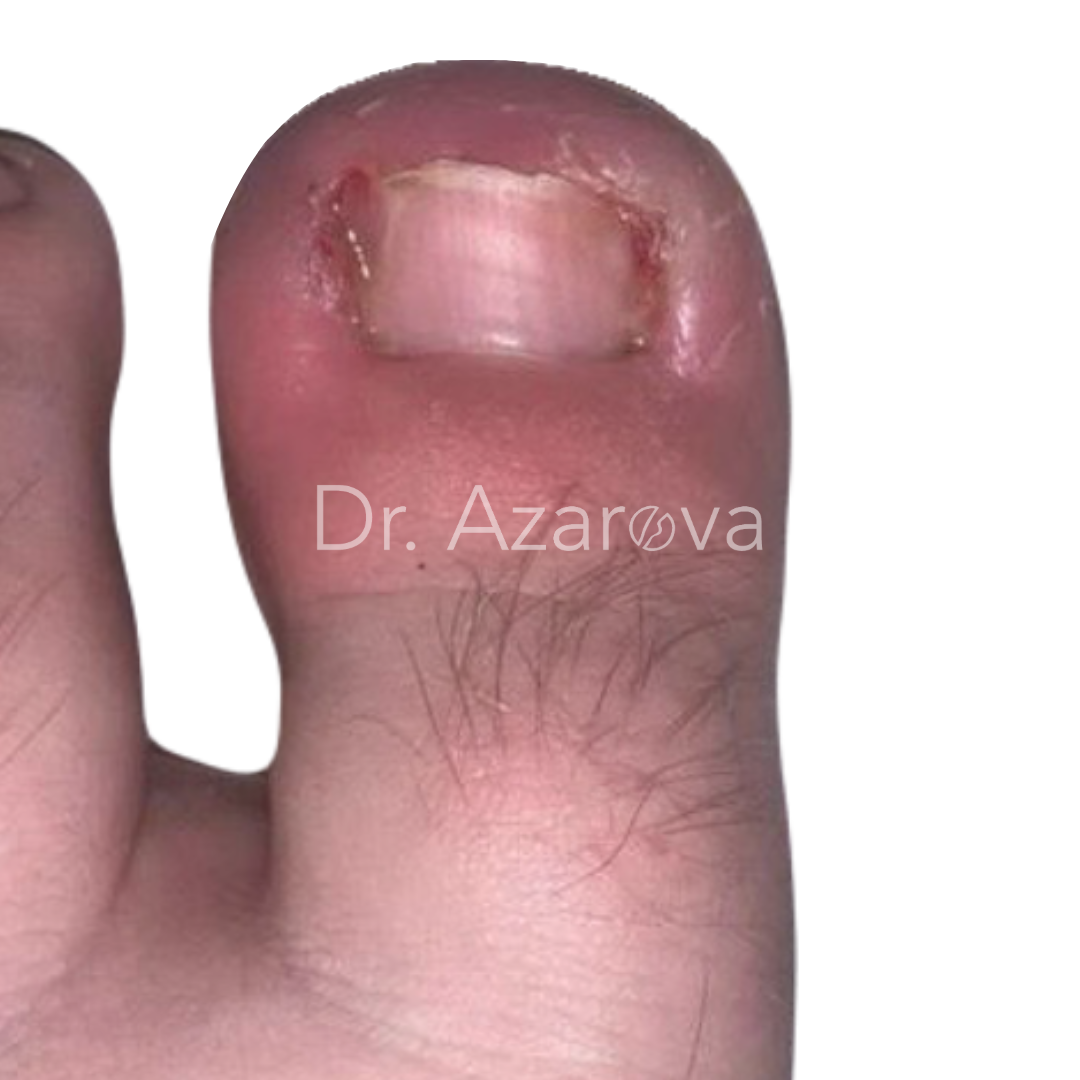 вросший ноготь результаты лечения, вросший ноготь на ноге, лечение вросшего ногтя, удаление вросшего ногтя, удаление ногтя, до и после, лечение до и после