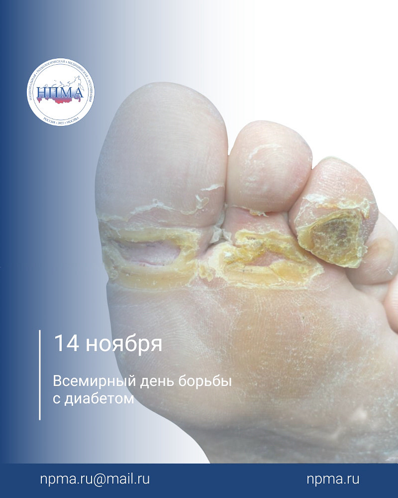 Всемирный день борьбы с диабетом диабетическая стопа, подолог, подиатр, диабет, врач