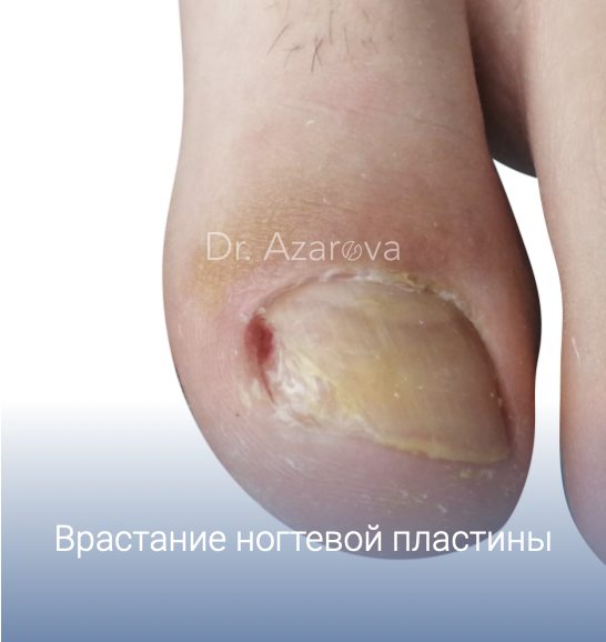 экзостоз, подногтевой экзостоз, вросший ноготь, удаление вросшего ногтя