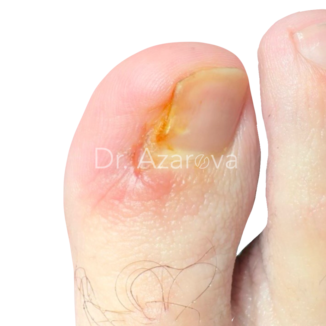 Вросший ноготь рецидив Вросшие ногти: причины, симптомы, диагностика, лечение, удаление, операция, фото, отзывы, лучшие врачи
