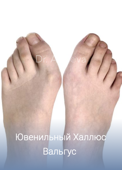 халюс Вальгус у детей: причины, симптомы, диагностика, лечение, профилактика, врач подолог хирург