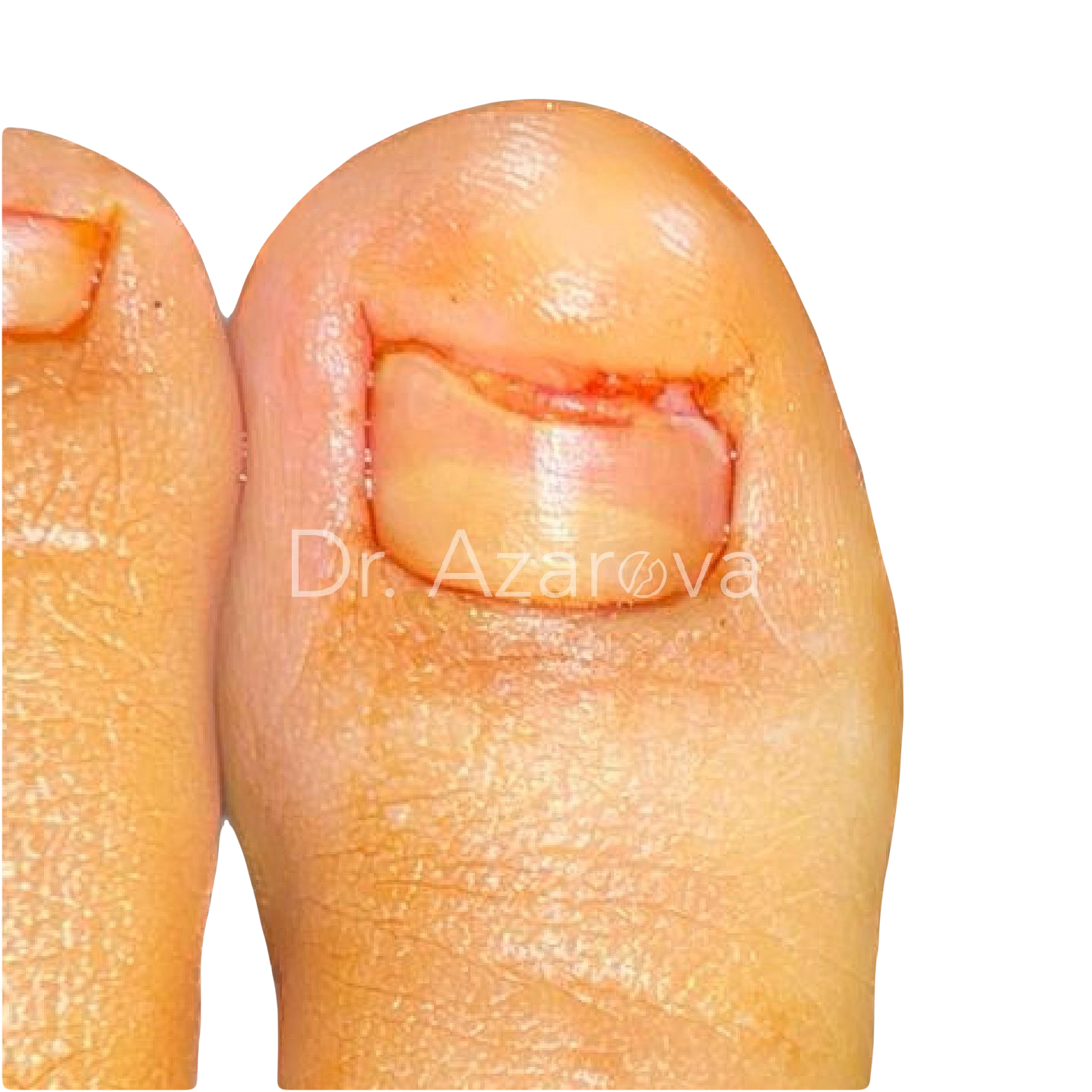 подногтевой экзостоз признаки