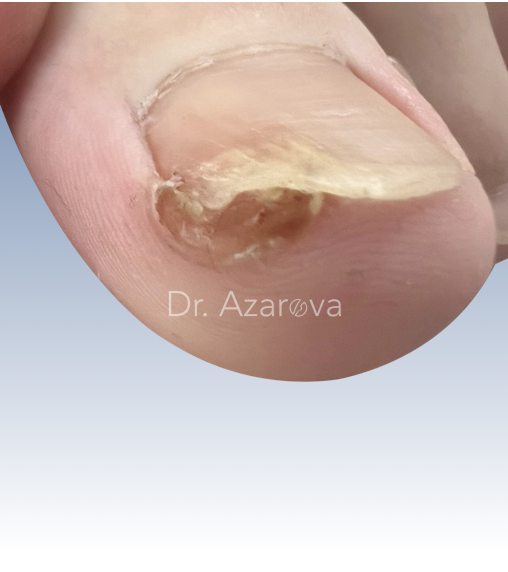 Вросший ноготь и остеохондрома вросший ноготь, вросший ноготь у подростка, удаление вросшего ногтя, лечение вросшего ногтя, ортониксия, титановая нить
