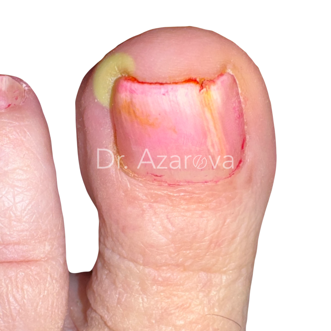Вросший ноготь на ноге: причины, симптомы, диагностика, лечение, удаление, операция, фото, отзывы, лучшие врачи