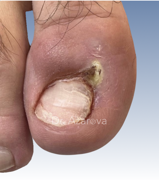 Остеомиелит при хроническо вросшем ногте вросший ноготь, удаление вросшего ногтя, остеомиелит от вросшего ногтя