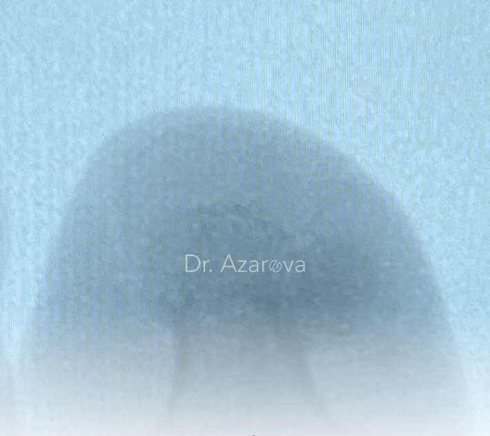 Рентген пальца стопы при остоехондроме рентген пальца остеохондрома, вросший ноготь, вросший ноготь на ноге, онихокриптоз, лечение вросшего ногтя, удаление вросшего ногтя