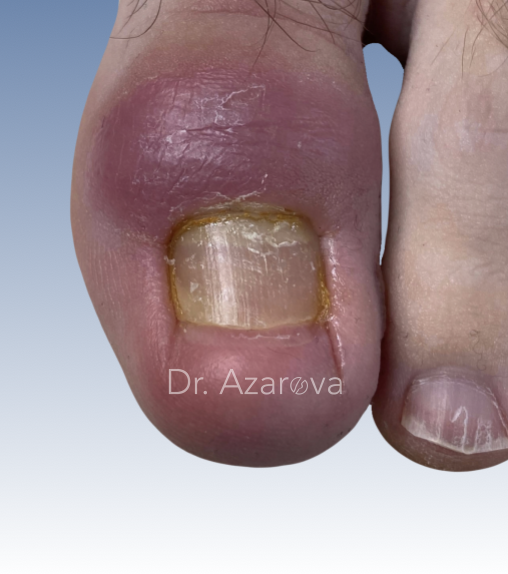 Ретронихия вросший ноготь, ретронихия, лечение вросшего ногтя, обратное врастание ногтя, удаление вросшего ногтя