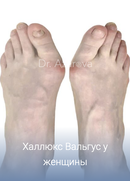 халюс Вальгус у женщин: причины, симптомы, диагностика, лечение, профилактика, врач подолог хирург