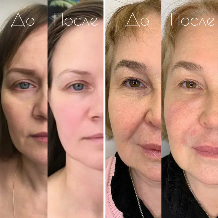 БМС лица Миоритм