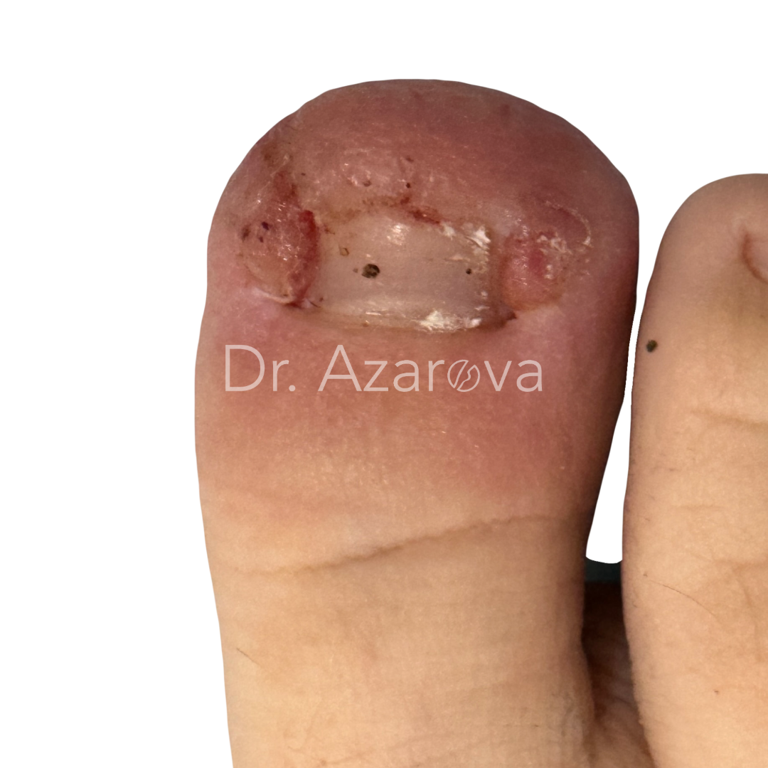 Вросший ноготь у ребенка Вросший ноготь у ребенка: причины, симптомы, диагностика, лечение, удаление, операция, фото