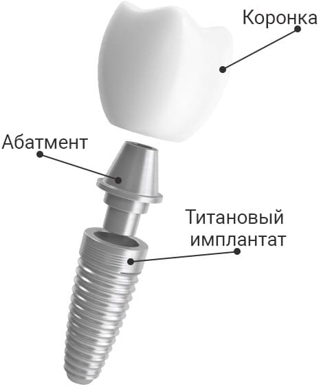 implantaciya zybov sevastopol