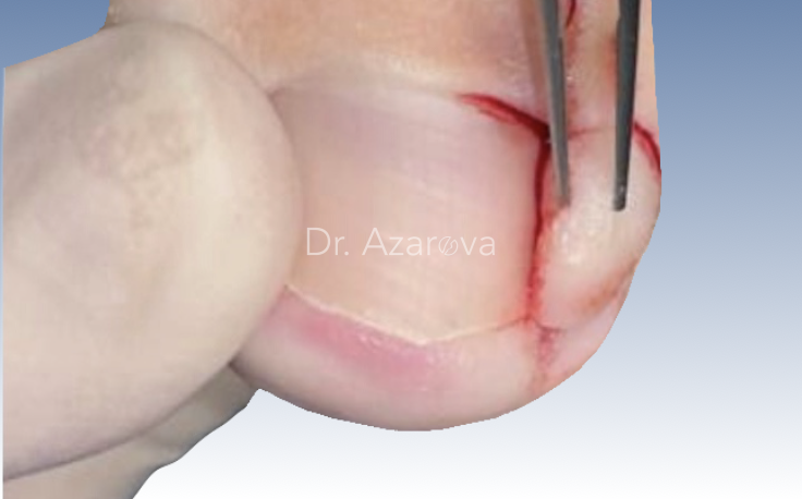 Лечение вросшего ногтя вросший ноготь, онихокриптоз, лечение вросшего ногтя, ортониксия, титановая нить, удаление вросшего ногтя, резекция вросшего ногтя, удаление ногтя