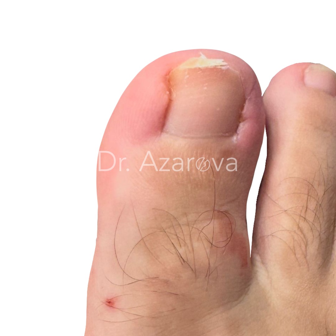 вросший ноготь результаты лечения, вросший ноготь на ноге, лечение вросшего ногтя, удаление вросшего ногтя, удаление ногтя, до и после, лечение до и после